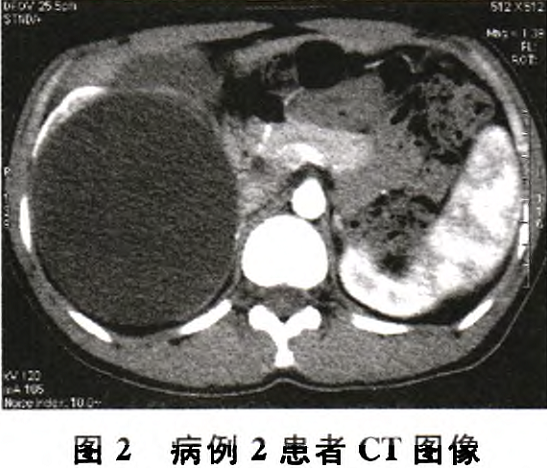 巨大肾积水误诊为肾囊肿4例