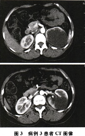 平扫及增强ct提示左肾上极一约6 厘米×8 厘米囊性包块考虑囊肿,左