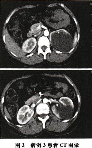 巨大肾积水误诊为肾囊肿4例