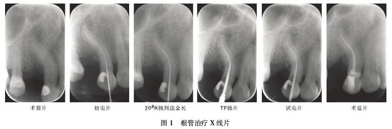 上颌尖牙s形根管1例