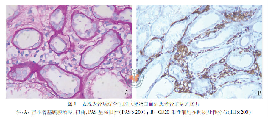 少量颗粒状沉积于系膜区,λ链(2  )沿毛细血管袢及肾小管基底膜线性