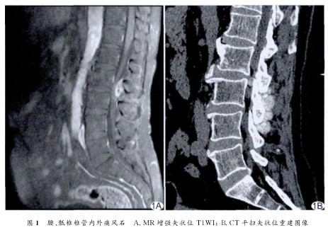 医学新闻 正文  ct:l2～s1椎体水平椎管内硬膜外,椎板内外及钩突小