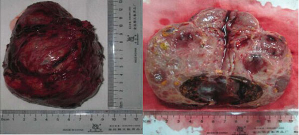 301医院教学病例:分泌雄激素的肾上腺皮质腺瘤致女性
