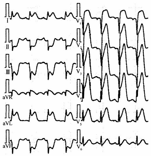 超急性期心肌梗死高耸t波误诊为高钾血症1例