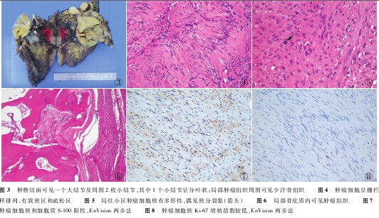 经典病例_肩胛骨巨大神经鞘瘤1例_医脉通