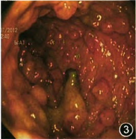 妊娠晚期急性重度溃疡性结肠炎并发肠穿孔1例