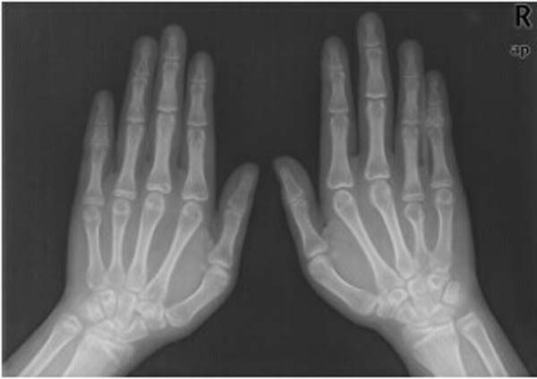 301医院教学病例:先天性卵巢发育不全综合征