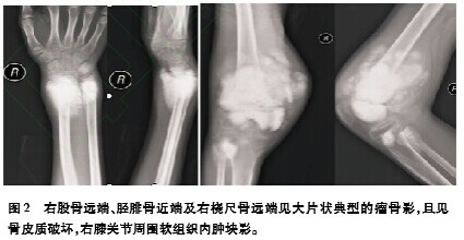 多发性成骨性骨肉瘤误诊