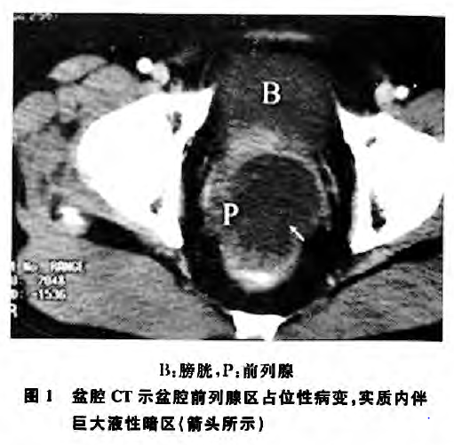 原发性前列腺黏液腺癌1例