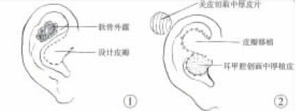 再造耳术后15年外伤耳软骨外露的手术治疗一例