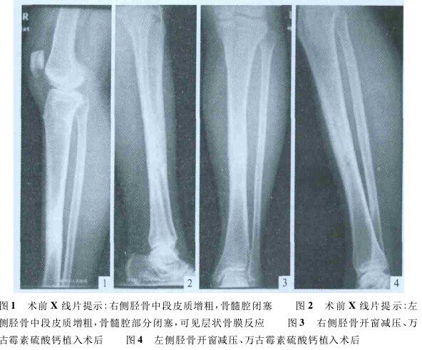 相继发生的双侧胫骨硬化性骨髓炎
