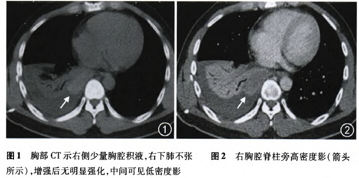 以血性胸腔积液为主要表现的右侧叶外型肺隔离症一例