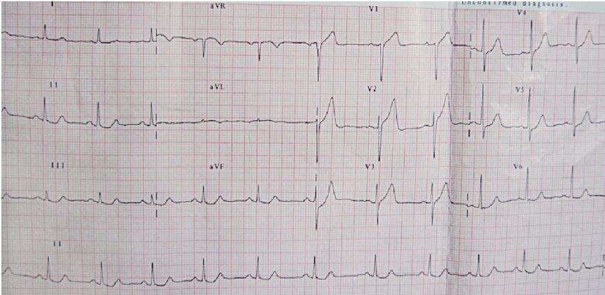 图2 7:56 am查心电图