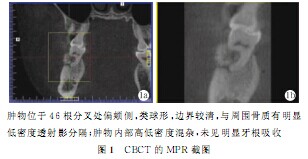 下颌骨牙槽突骨软骨瘤1例