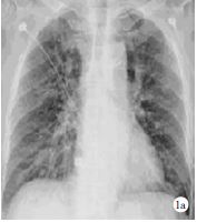 x线胸片提示:慢性支气管炎征象,右下肺感染,见图1a.