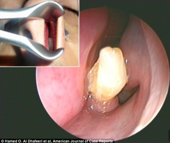 不明鼻出血竟因鼻腔内长牙