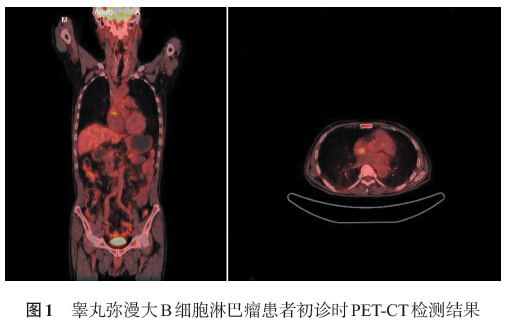 原发睾丸弥漫大b细胞淋巴瘤心脏侵犯一例