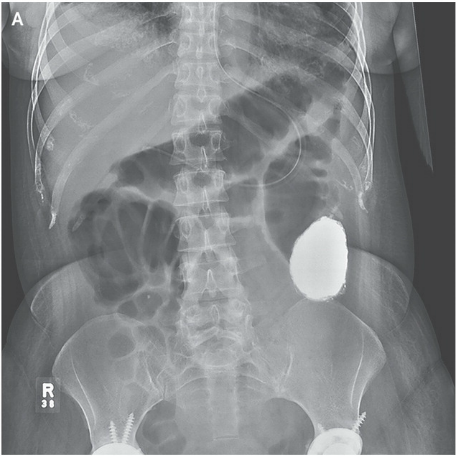 接受急诊治疗时 ,腹部x线显示在近端乙状结肠(图a)有一5cm钡结石造成