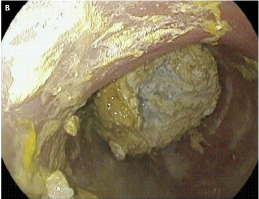 【nejm图片病例】钡造影后引发的顽固性便秘1例
