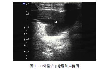 口外型舌下腺囊肿1例超声误诊原因分析