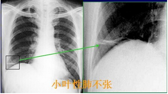 x线表现:片状淡薄的高密度影,边缘模糊;与肺叶或肺段形态一致的高图片