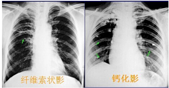 肺部常见病变的x线片总结