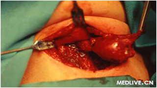甲状腺癌:甲状舌骨囊肿癌变并发