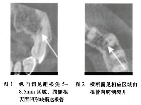 老人拔牙后的症状