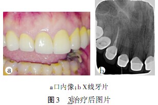 锥形束ct辅助纠正窦型慢性根尖脓肿牙位误诊1例