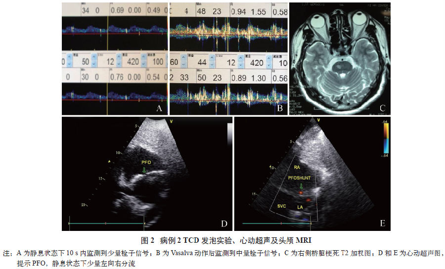 卵圆孔未闭导致反复跌倒发作2例