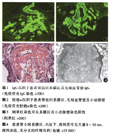 肾活检病理:免疫荧光可见5个肾小球,igg 2 [系膜(ms) 血管壁(gcw),见