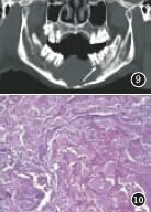 牙源性钙化上皮瘤2例