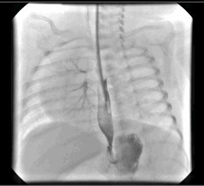 【nejm图片病例】新生儿气管食管瘘1例