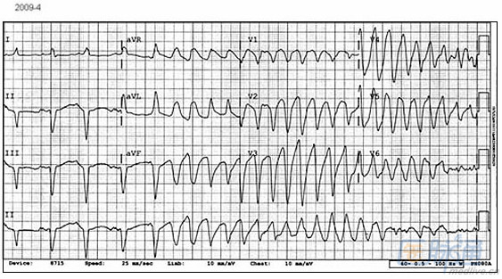 不可错过的心电图发现:那些危及生命的情况(转自医脉通)