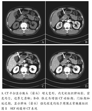 胰腺硬化性上皮样纤维肉瘤