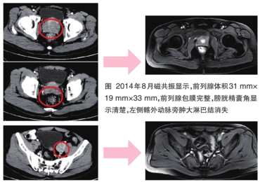 成功治疗1例晚期前列腺癌患者