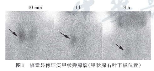 多发性骨髓瘤误诊为甲状腺功能减退症