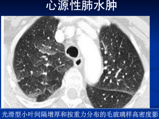如何诊断肺水肿 1418723684880.png