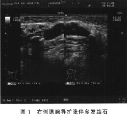 超声诊断双侧腮腺导管多发结石伴慢性腮腺炎1例