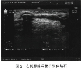 超声诊断双侧腮腺导管多发结石伴慢性腮腺炎1例