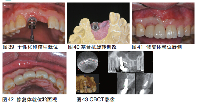 前牙美学区叶片种植体沉睡并悬臂梁种植固定桥修复