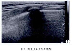 骨软骨瘤恶变后存活率 哪个保险可以保软骨瘤