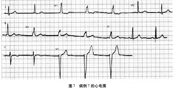 转载:13个案例,图解林林总总的室性融合波