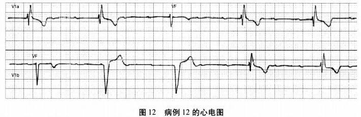 转载:13个案例,图解林林总总的室性融合波