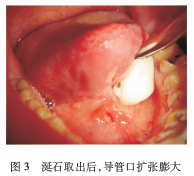 舌下区黏膜肿块,是何原因?