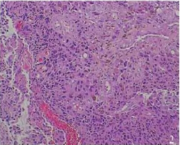 核分裂象易见,见少量黑色素颗粒(he 20×)   病理组织学检查示肿瘤
