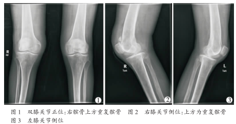 经典病例_重复髌骨1例