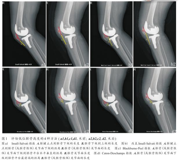 本例病人手术前后4种评估髌骨高度方法的示意图(图1,手术前后4种指数