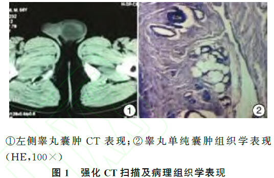 睾丸白膜囊肿1例