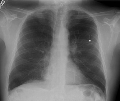 胸片示左肺上叶可见小结节(图2).